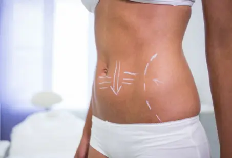 CoolSculpting vs Liposuction