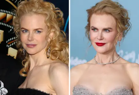 nicole kidman plastic surgery