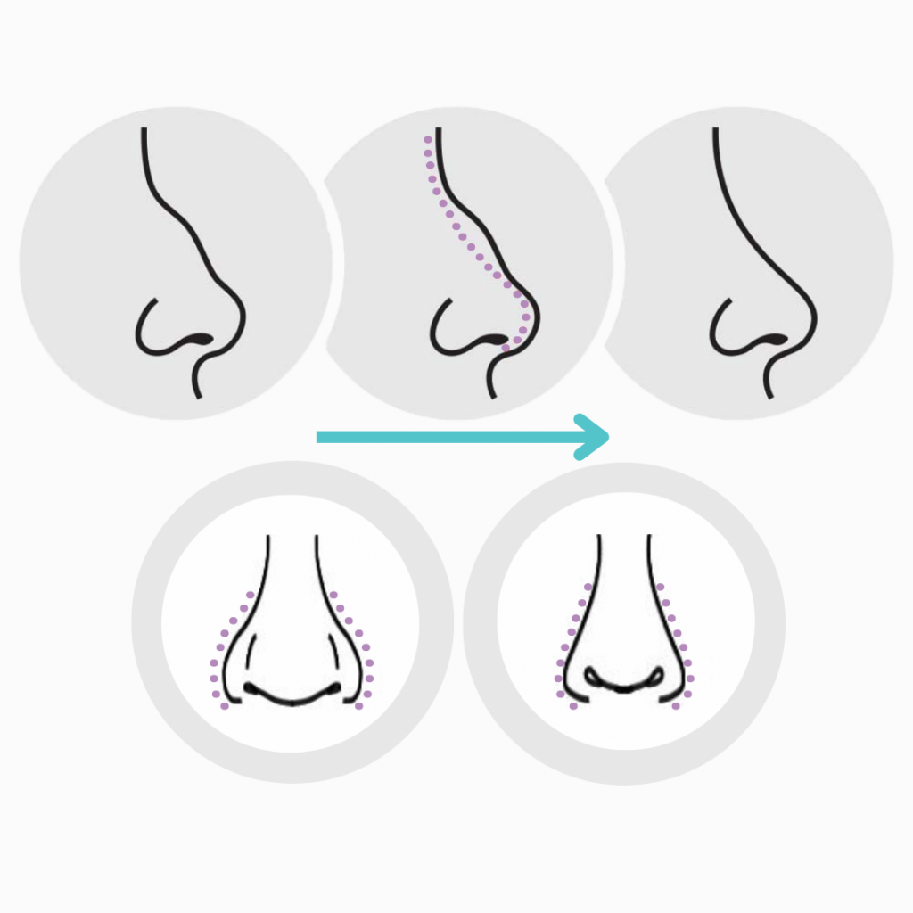 Nose job diagram