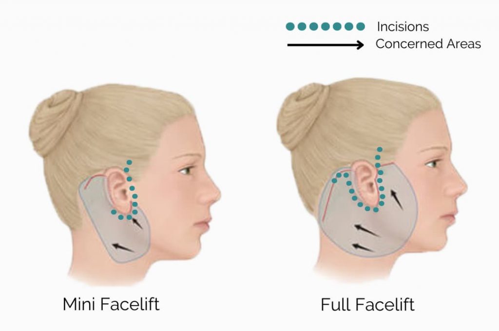 Mini facelift full facelift 