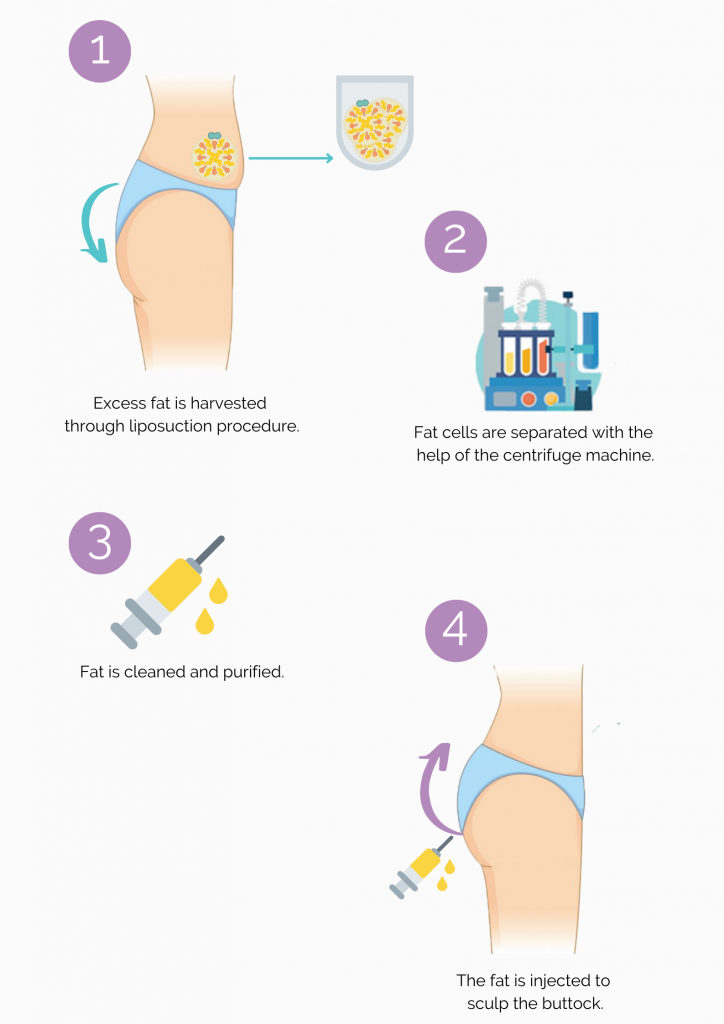 BBL Surgical Process