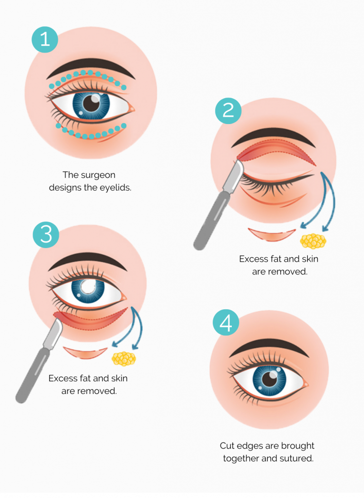 Eyelid General