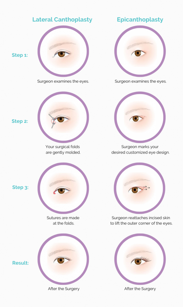 Lateral and Epicanthoplasty