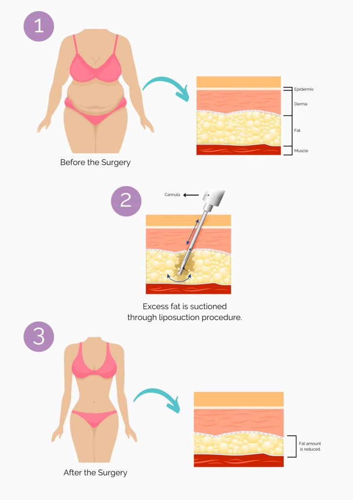 Liposuction surgical process