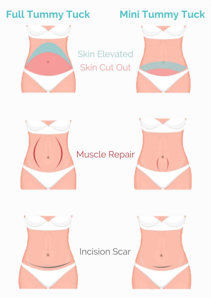 Mini full tummy tuck