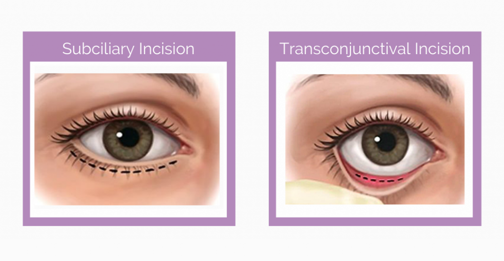 Subciliary Transconjunctival Incisions 1