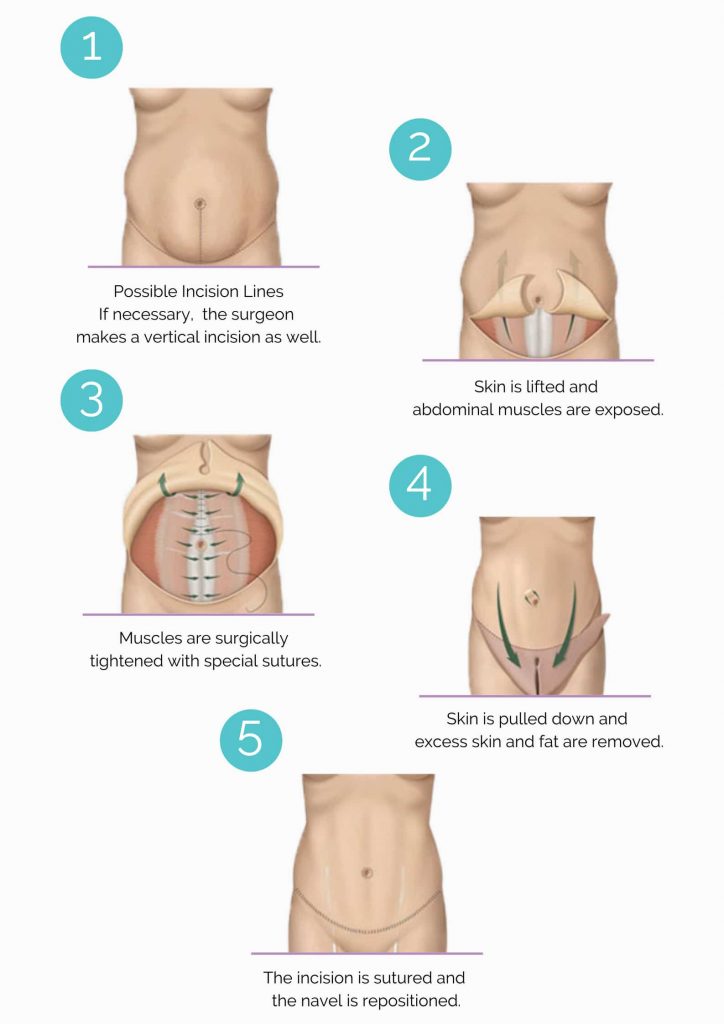 Tummy Tuck General Information