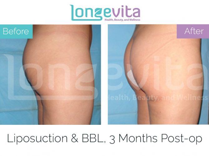 How Much Is The Brazilian Buttlift Surgery In Turkey - BBL