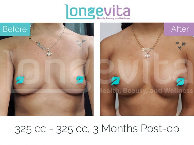 Breast Explant Surgery 3 Months Post Op 