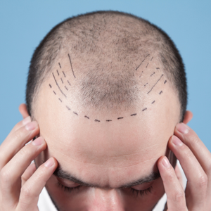 hair transplant