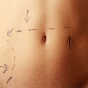 tummy tuck 350x350 1