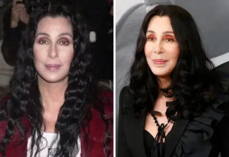 cher plastic surgery