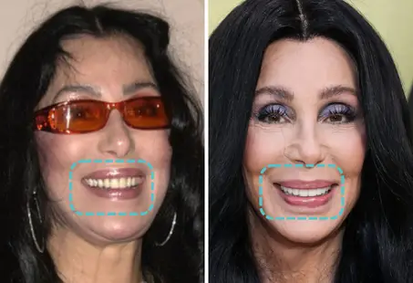 cher teeth