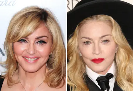 madonna plasrtic surgery