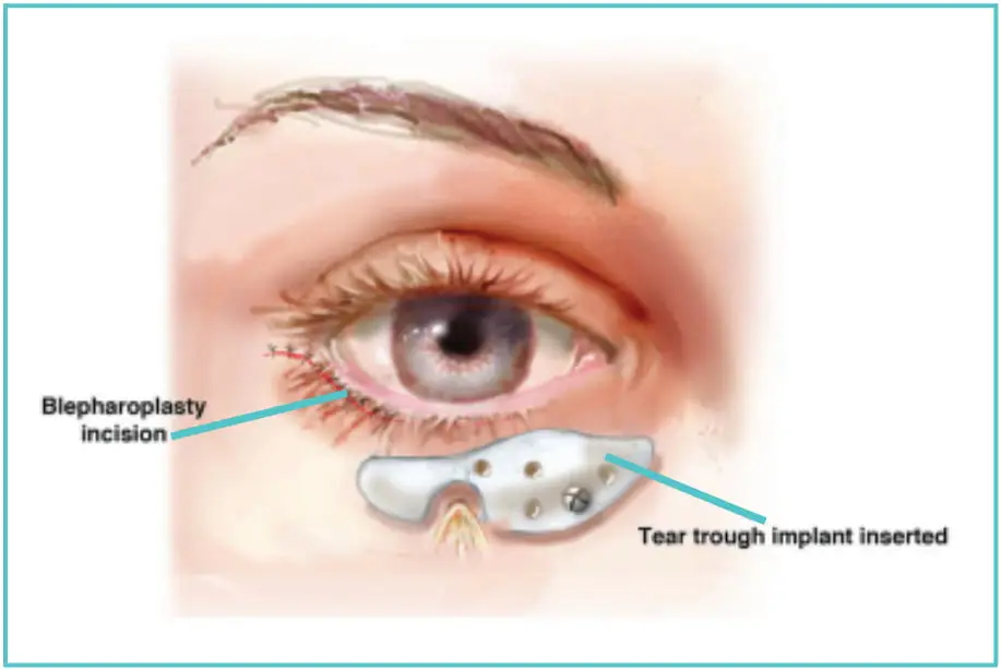 eyelid implant