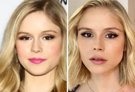 erin moriarty blepharoplasty 