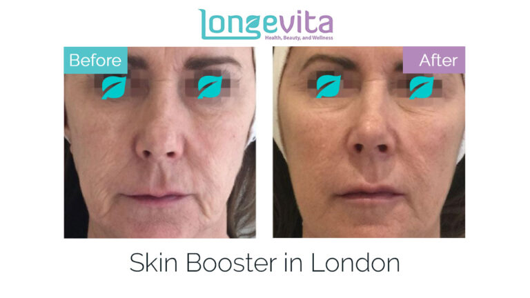 skin boosters in london