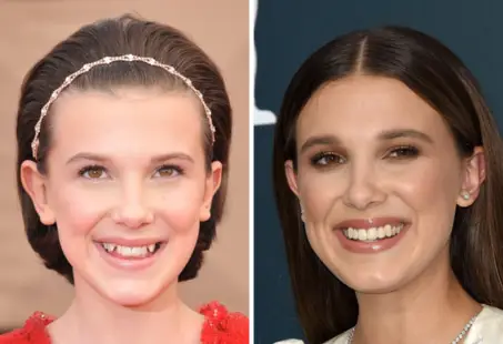 millie bobby brown teeth (1)