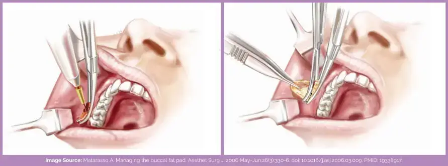 Bichectomy procedure