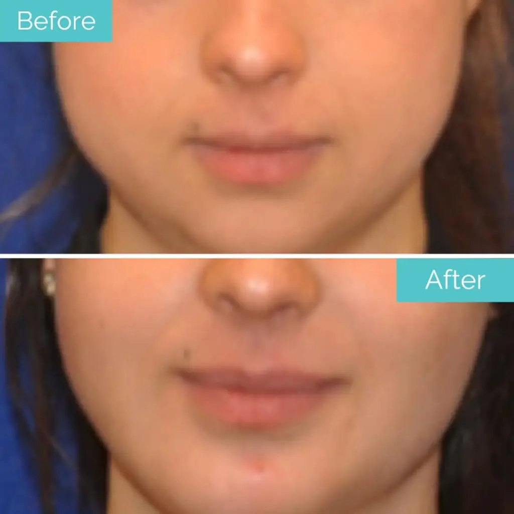 buccal fat removal before after