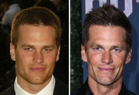 tom brady plastic surgery