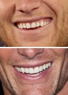 tom brady cosmetic dentistry