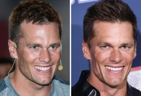 tom brady hair transplant (3)