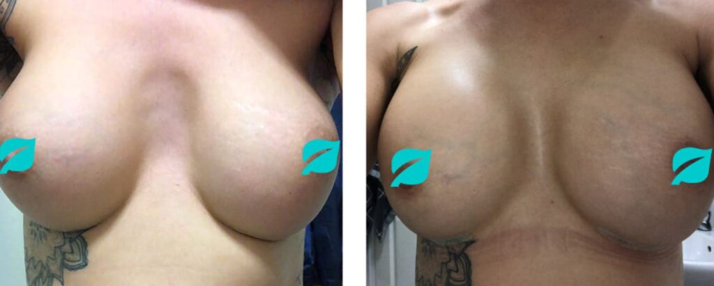 Improper implant placement and wide breasts