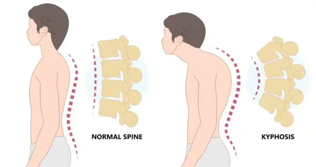 Kyphosis