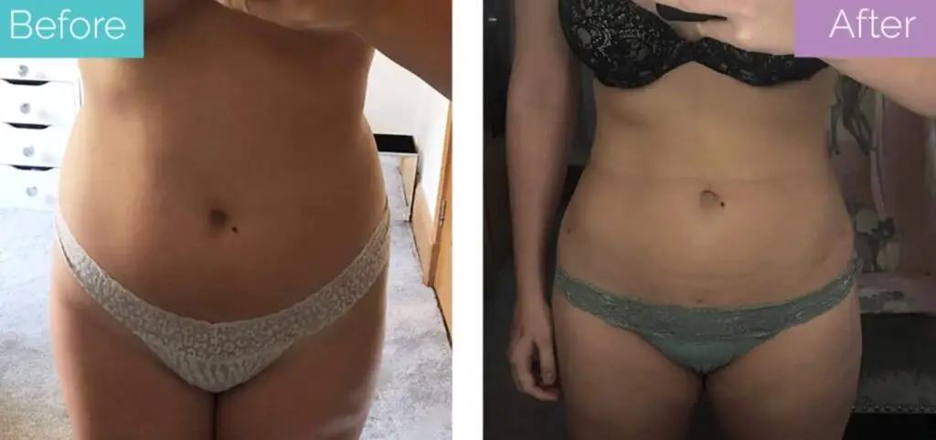 Liposuction before and after