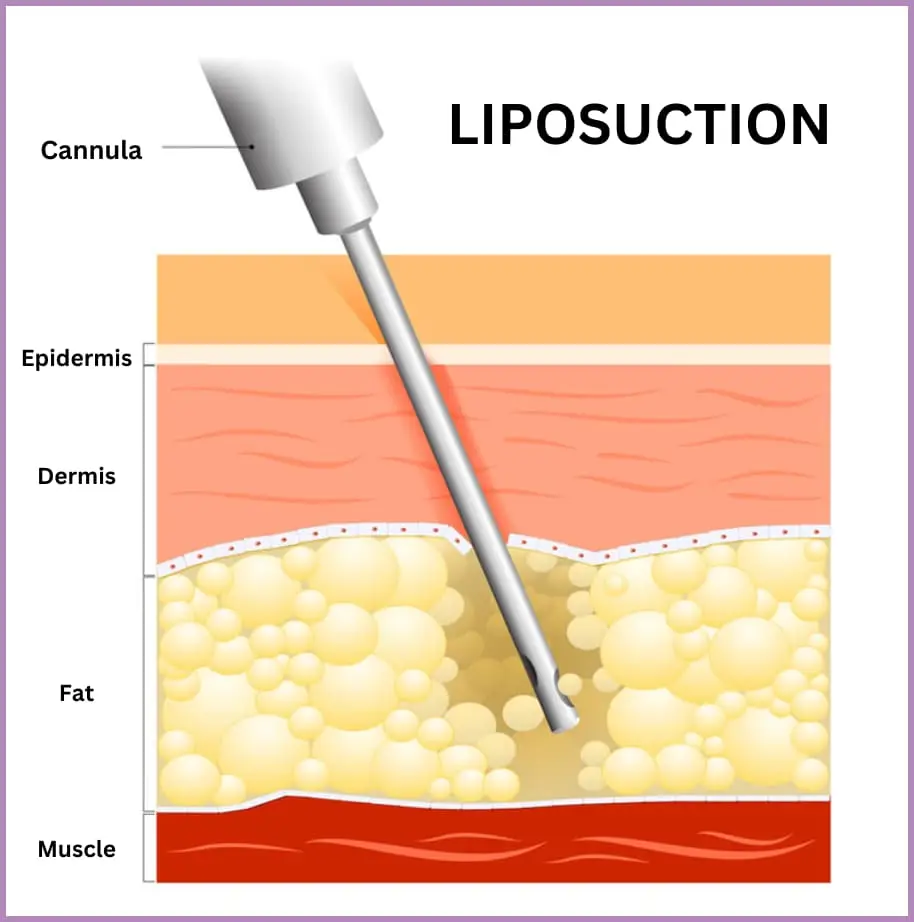 Liposuction procedure