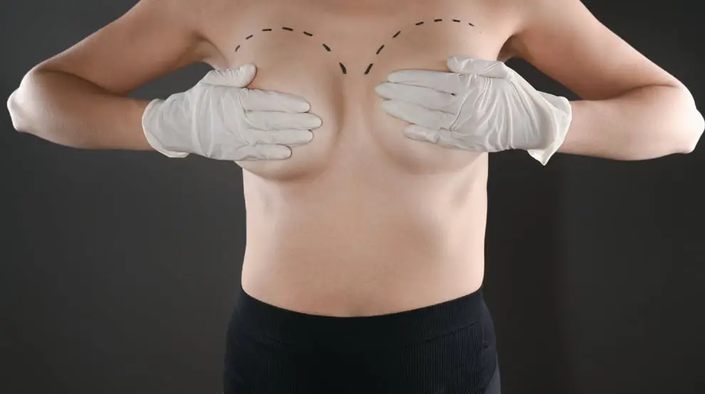 Breast surgery