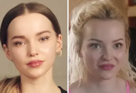 dove cameron plastic surgery