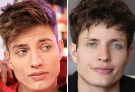 matt rife plastic surgery 3