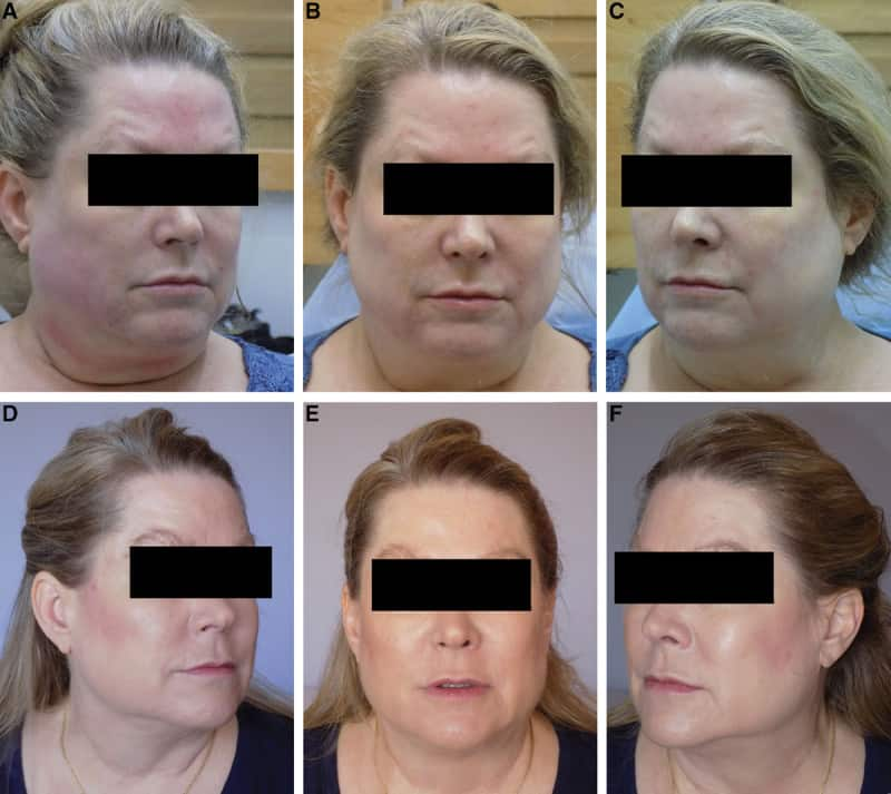 Ultherapy before and after