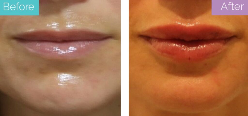 lip filler before and after