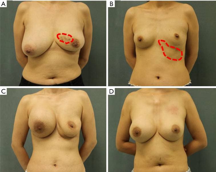 PAAG breat filler complications