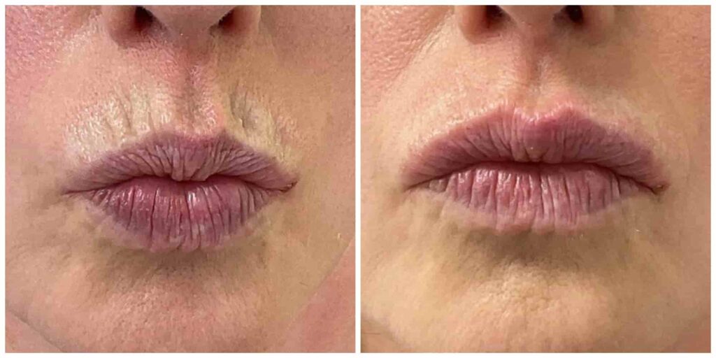 dermal filler for smokers lines before and after