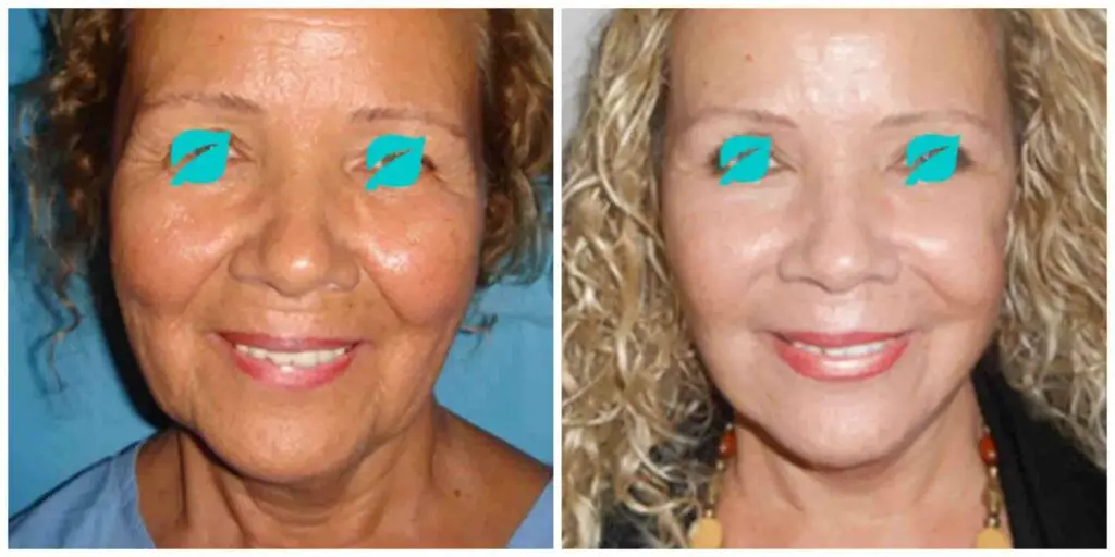 facelift before and after