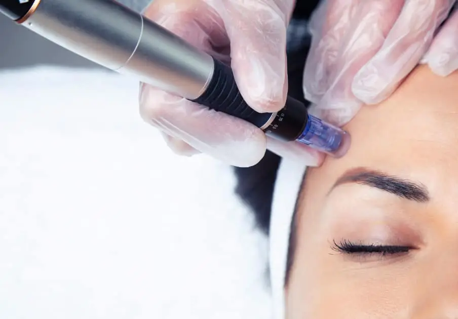 microneedling