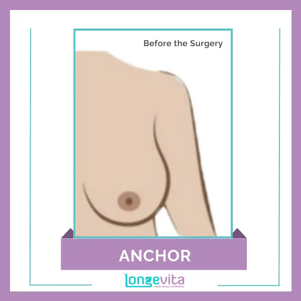 Anchor Breast Reduction Before the Surgery