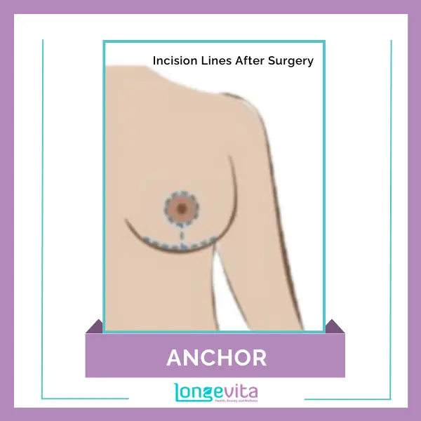 Anchor Breast Reduction Incision Lines After Surgery