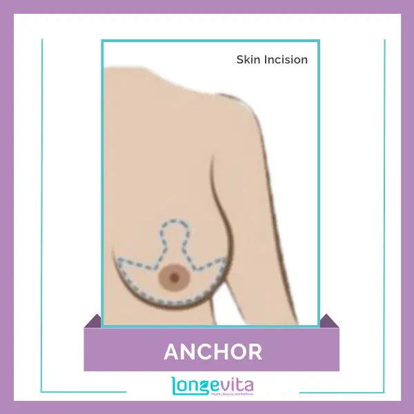 Anchor Breast Reduction with Skin Incision