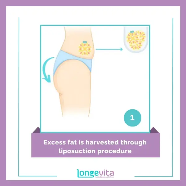 1 Excess fat is harvested through liposuction procedure