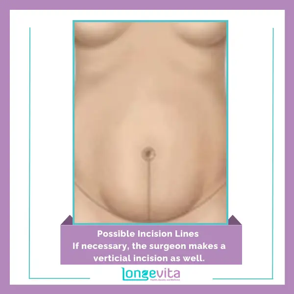 1 Possible Incision Lines For Tummy Tuck