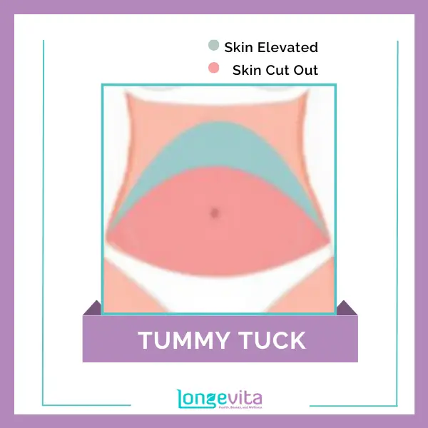 1 Tummy Tuck skin elevated & cut out