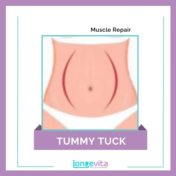 2 Tummy Tuck Muscle Repair