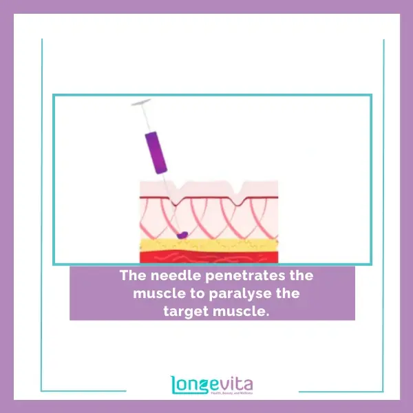 2 the needle penetrates the muscle to paralyse the target muscle