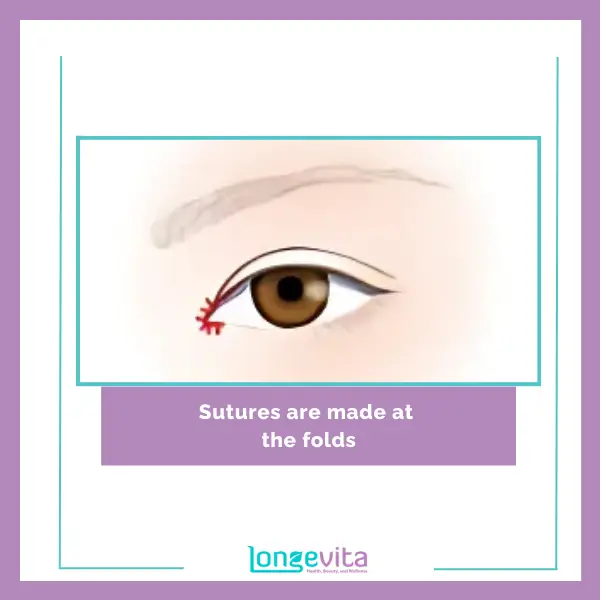 3 Sutures are made at the folds