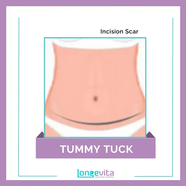 3 Tummy Tuck Incision Scar